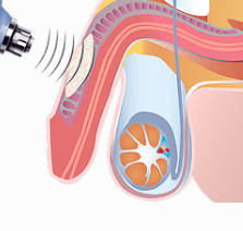 Гипертермотерапия. Лечение хронического простатита
