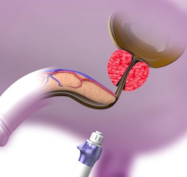 Урарно волновая терапия при заболеваниях простаты