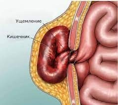 Паховая грыжа Паховая грыжа