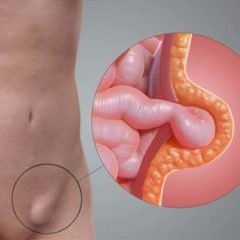 Паховая грыжа Паховая грыжа