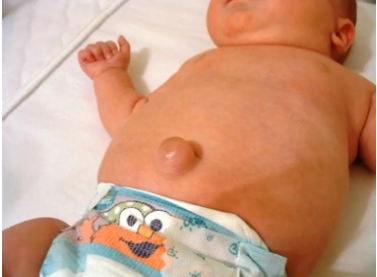 Пупочная грыжа